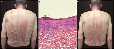 Case report: Treatment of psoriasiform dermatitis in patients with malignancy